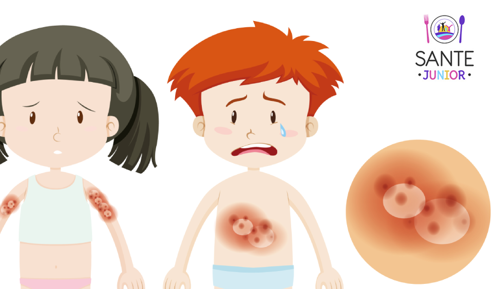 Cateva detalii despre aparitia eczemelor la copii